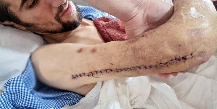 پیوند موفقیتآمیز دست جداشده یک کارگر در یزد پیوند موفقیتآمیز دست جداشده یک کارگر در یزد
